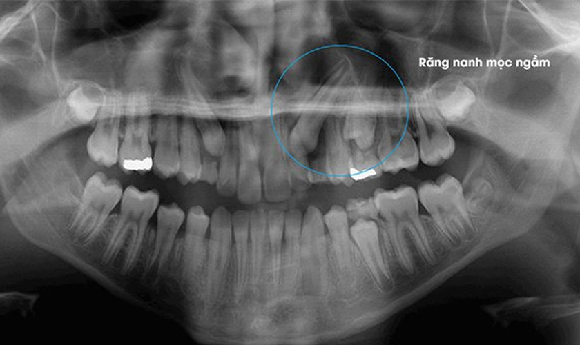 Phương pháp xử trí răng nanh mọc ngầm